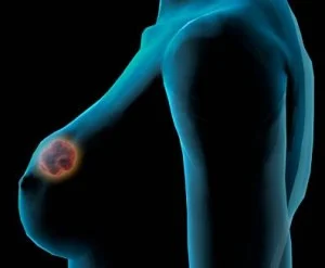 Projeto de Promoção da Saúde da Mulher oferece mamografias gratuitas