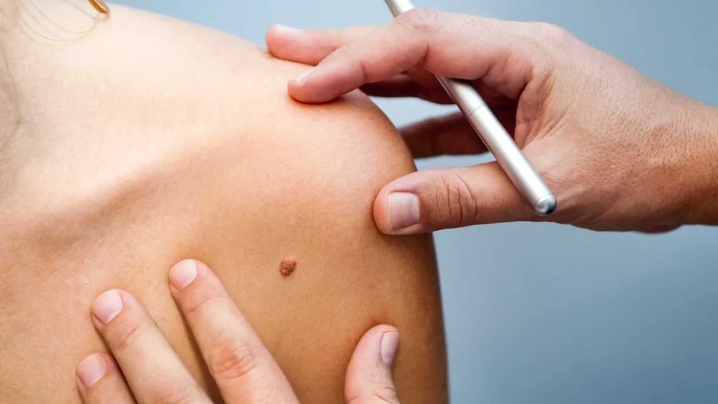 Imunoterapia pode frear metástase no cérebro