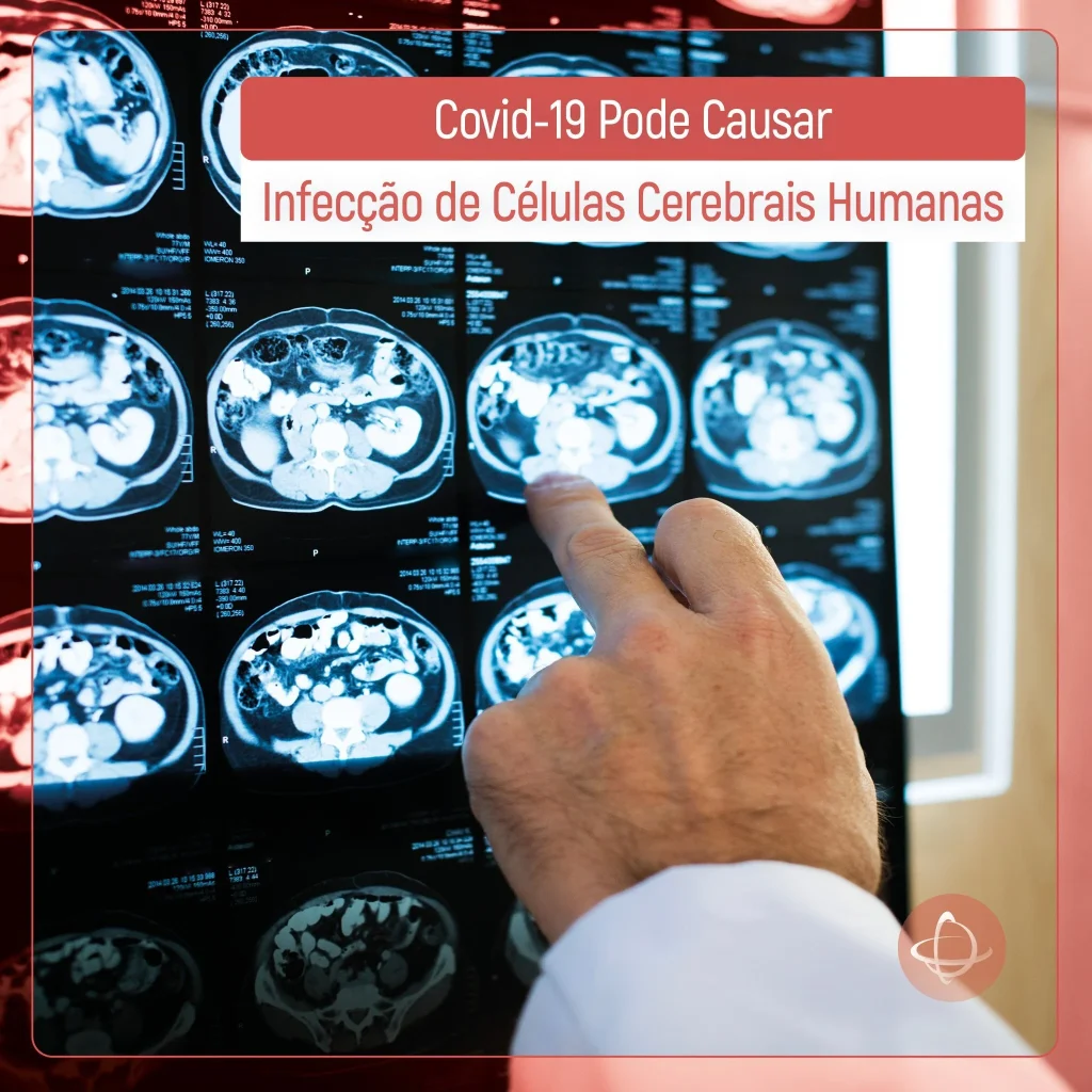 Covid-19 pode causar infecção de células cerebrais humanas