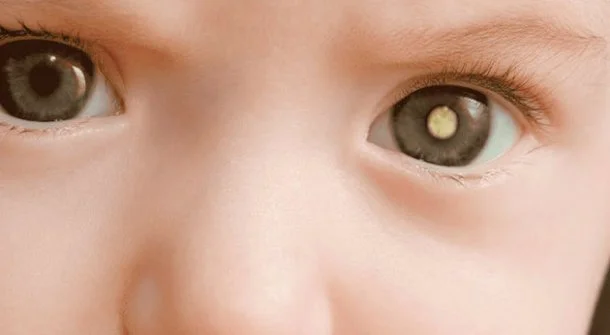 Retinoblastoma: tipo raro de câncer ocular que acomete crianças
